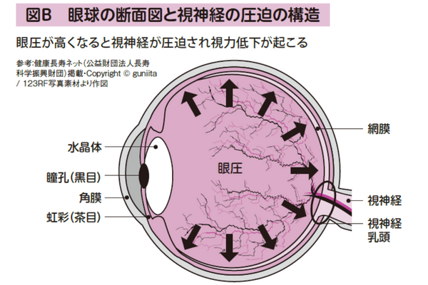 眼球の断面図と視神経の圧迫の構造