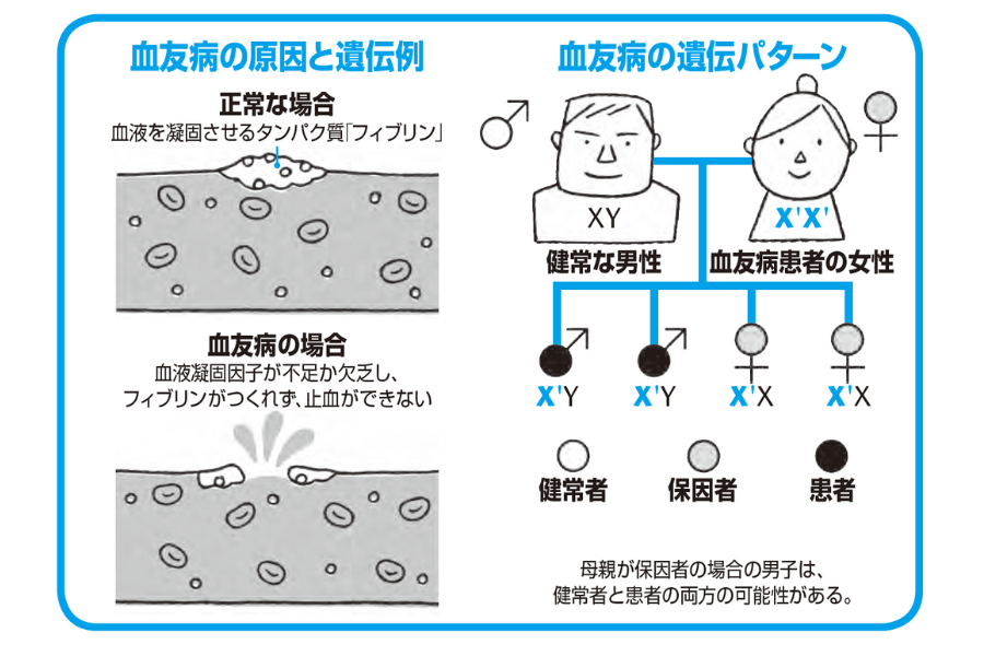 血友病の原因と遺伝例『眠れなくなるほど面白い 図解 病理学の話』