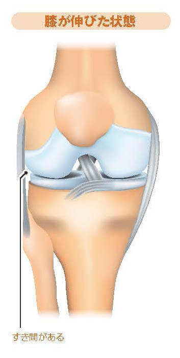 膝が伸びた状態【スポーツ障害予防の教科書】