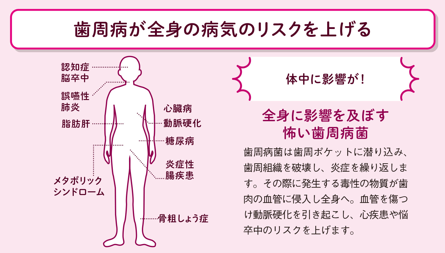 歯周病菌が動脈硬化の原因に【図解 血管・血液の話】