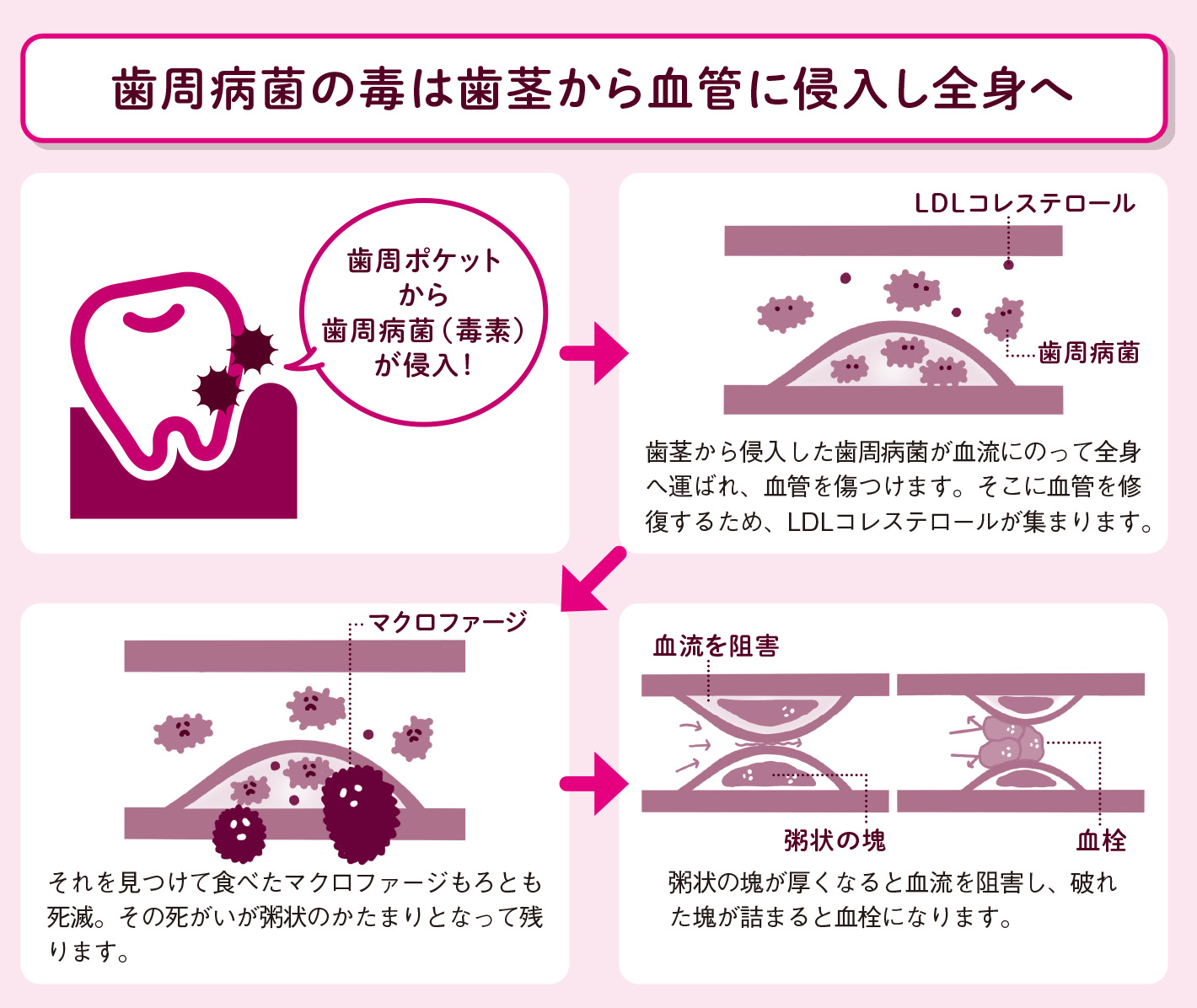 歯周病菌が血管内で血流を阻害する【図解 血管・血液の話】