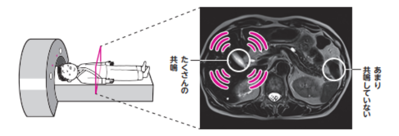 MRI画像